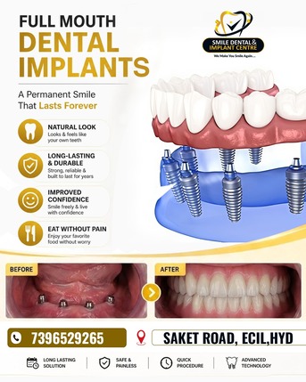 Advanced Dental Clinic In Sainikpuri For Dental Implants