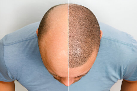 Hair Transplant Cost In Bhopal – What Will You Actually Pay? photo 1