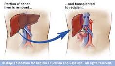 Liver Transplant in India photo 1