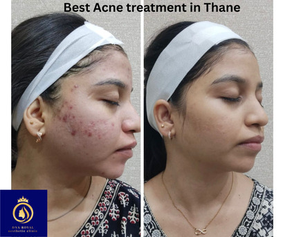 Best Acne Treatment In Thane – Advanced Acne Care At DNA Royal. photo 1