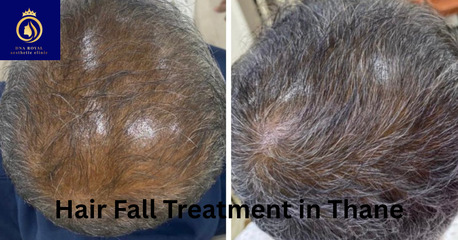 Best Hair Fall Treatment In Thane – Expert Solutions At DN A Royal. photo 1