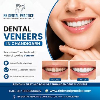 Dental Veneers In Chandigarh For Cosmetic Smile Enhancement