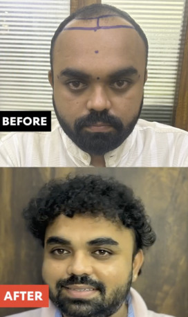 Best Hair Transplant In Gujarat photo 1