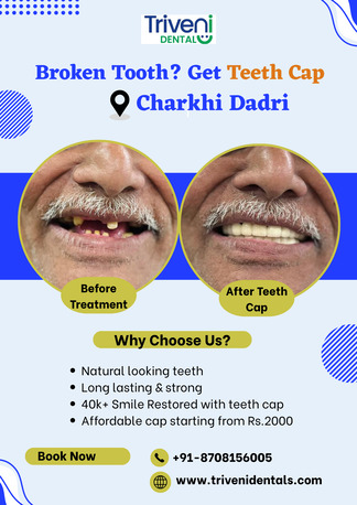 Teeth Cap Treatment In Charkhi Dadri | Triveni Dental photo 1