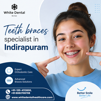Teeth Braces Specialist In Indirapuram For Better Smile Alignment