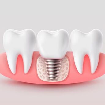 Get Back Your Complete Smile At A Trusted Dental Implant Clinic In Kolkata