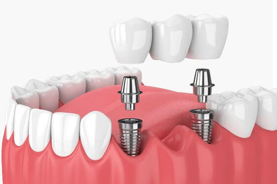 Best dental bridge treatment in Preet Vihar
Delhi photo 1