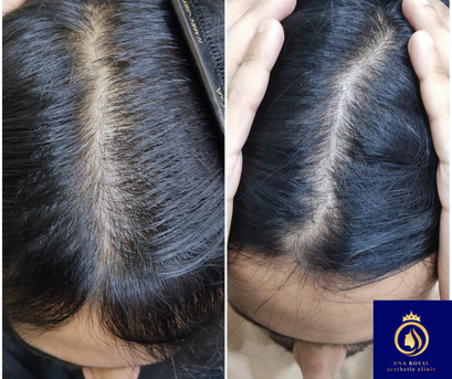 DNA Royal Offers The Best Hair Regrowth For Women In Thane. photo 1