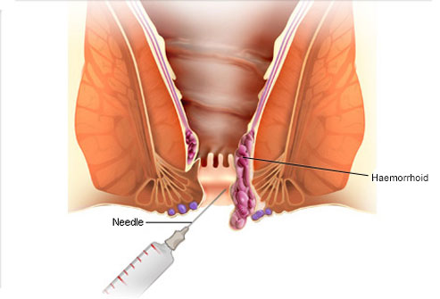Piles Treatment in Chennai photo 1