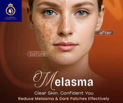 Trusted Clinic For The Best Melasma Treatment In Thane | DNA Royal. photo 1