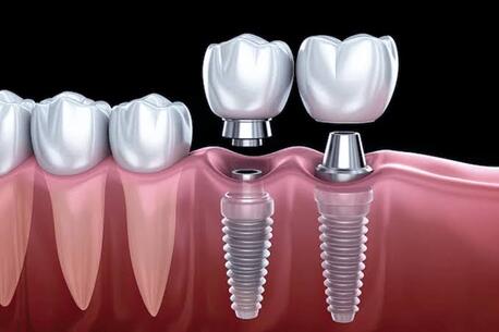 Dental Implants In Delhi NCR photo 1