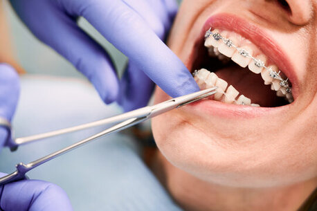 Braces Treatment In Pune | Affordable Orthodontic Care photo 1