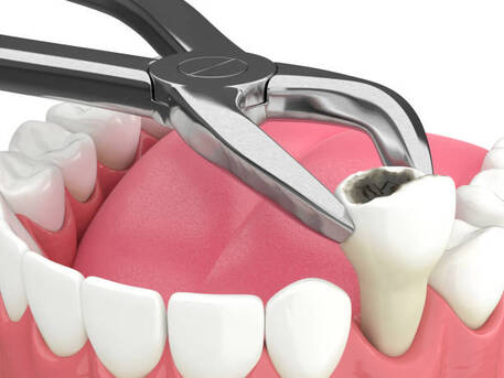 Tooth Extraction In NIBM Pune | Safe & Painless Dental Care