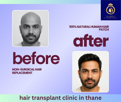 Hair Transplant Clinic In Thane – Expert Hair Restoration At DNA Royal.